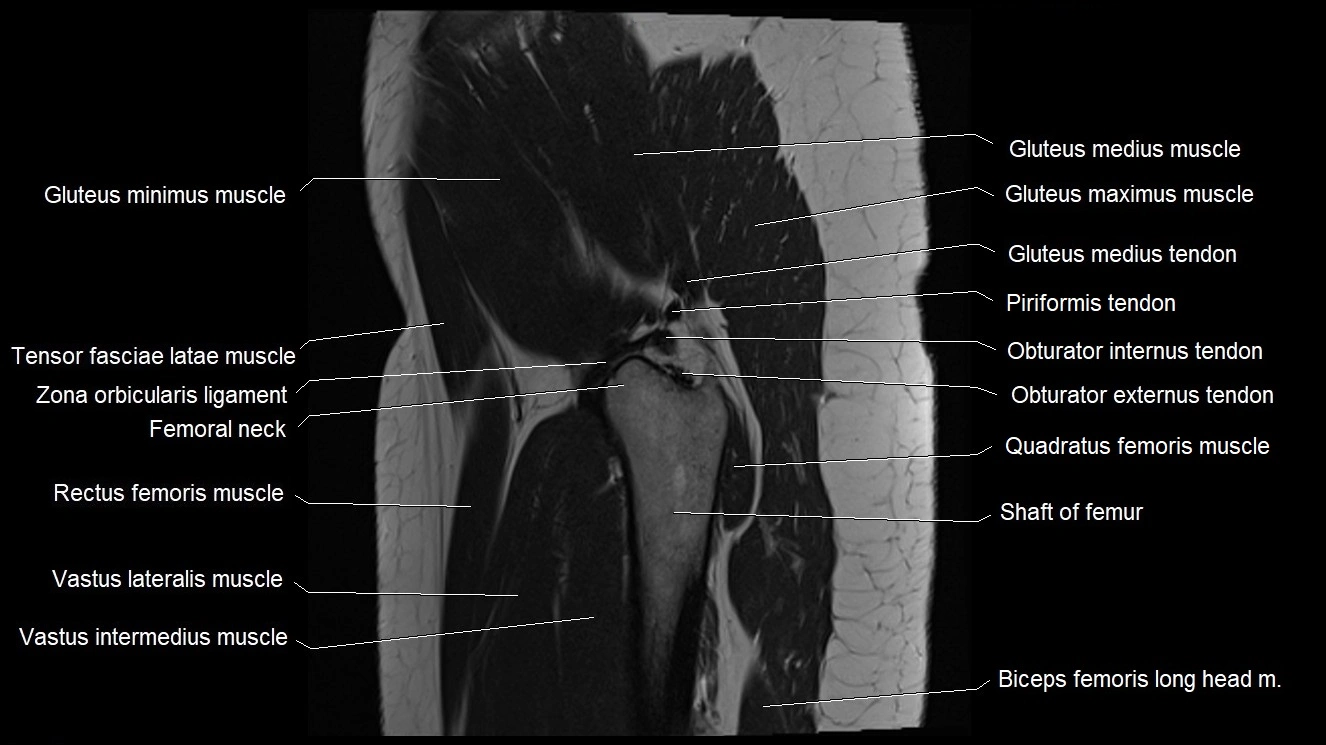 Hip sagittal cross sectional anatomy image 10.webp